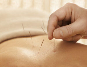 Several acupuncture needles placed in patients back