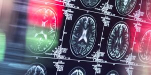 Fentanyl inhalation may cause potentially irreversible brain damage