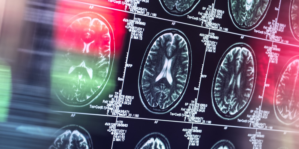 Fentanyl inhalation may cause potentially irreversible brain damage