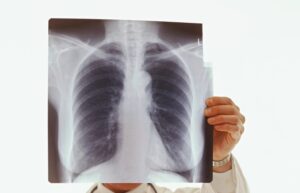 Chest x-ray