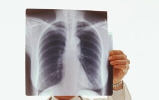 Chest x-ray